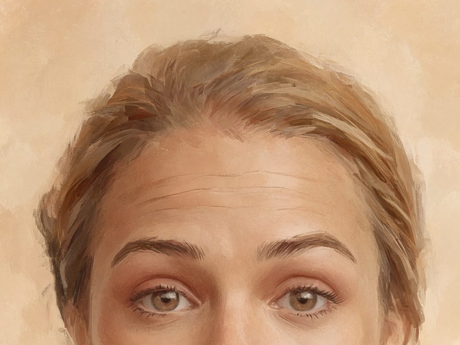 Illustration avant : rides horizontales du front marquées en haussant les sourcils, femme, 30-35 ans (illustration, pas un patient réel)